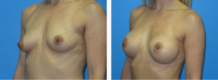 Breast Augmentation before and after treatment