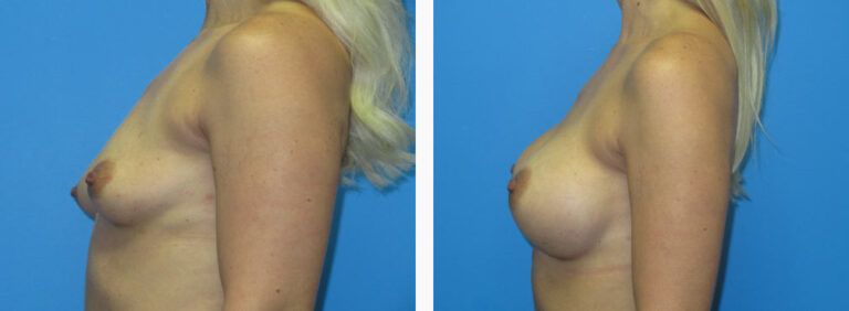 Breast Augmentation before and after treatment