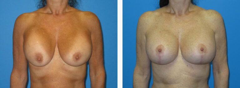 Breast Augmentation before and after treatment