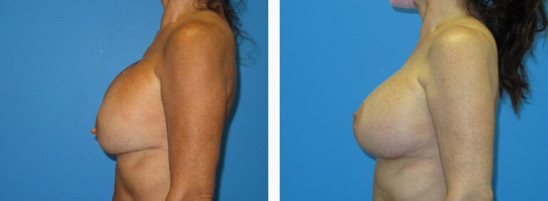 Breast Augmentation before and after treatment