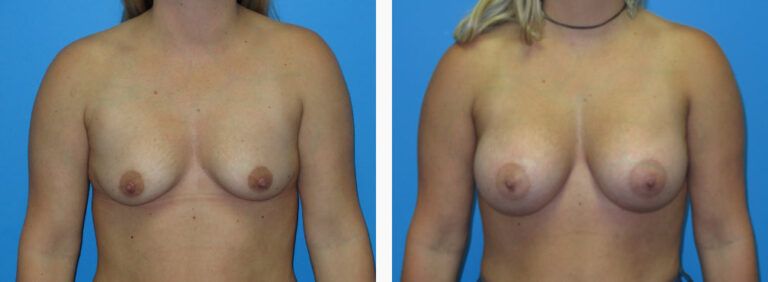 Breast Augmentation before and after treatment