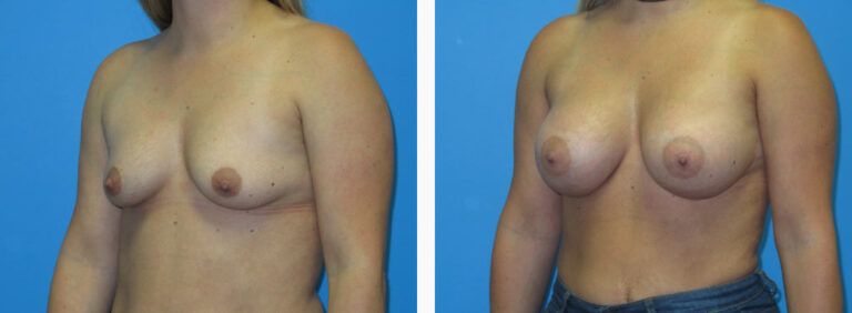 Breast Augmentation before and after treatment