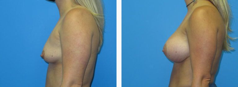 Breast Augmentation before and after treatment