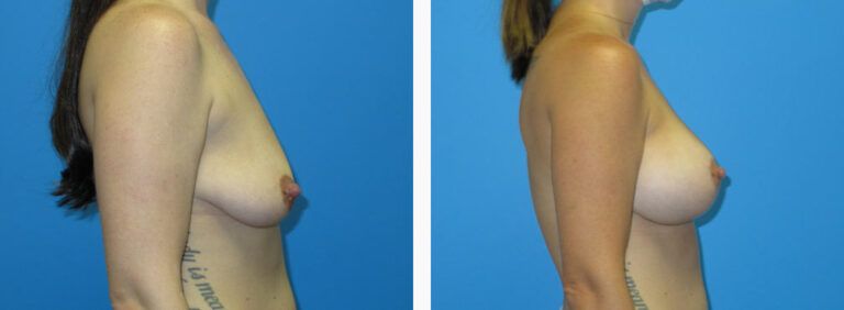 Breast Augmentation before and after treatment
