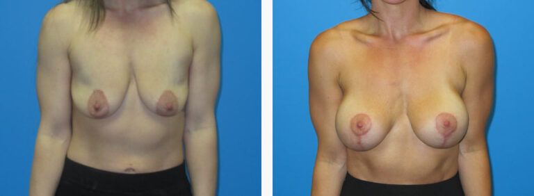 Breast Augmentation before and after treatment