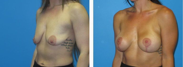 Breast Augmentation before and after treatment
