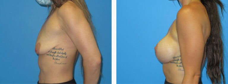 Breast Augmentation before and after treatment