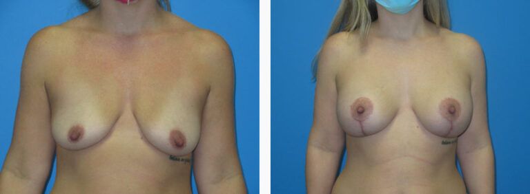 Breast Augmentation before and after treatment