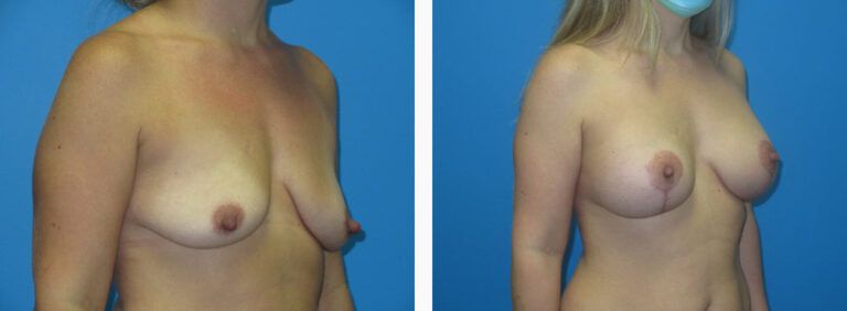 Breast Augmentation before and after treatment
