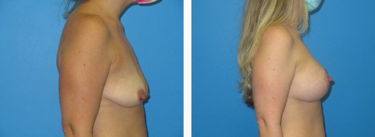 Breast Augmentation before and after treatment