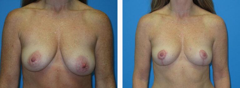Breast Lift before and after treatment