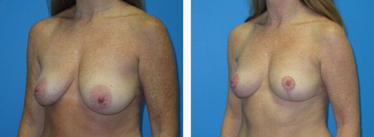 Breast Lift before and after treatment