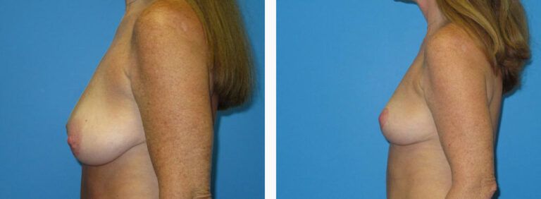 Breast Lift before and after treatment