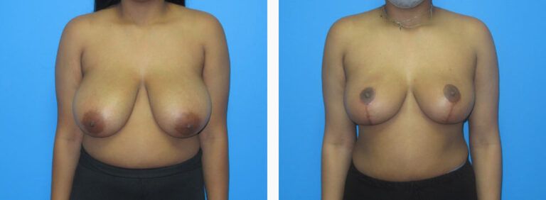 Breast Reduction before and after treatment