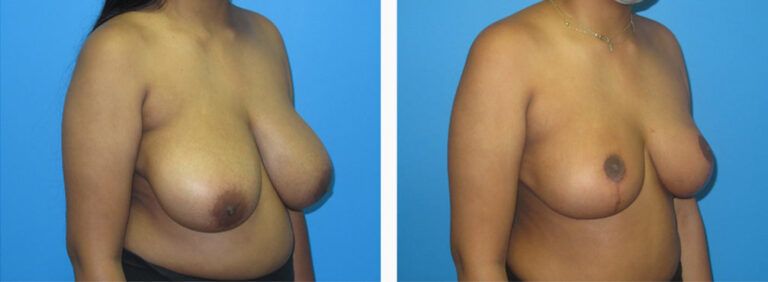 Breast Reduction before and after treatment
