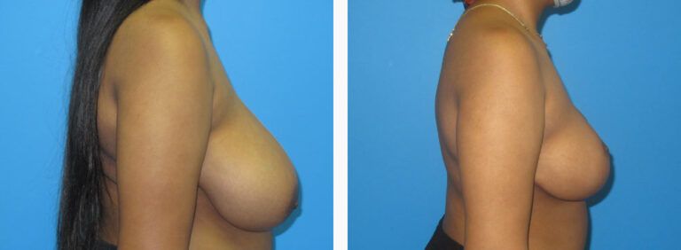 Breast Reduction before and after treatment