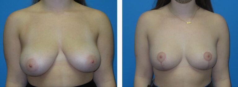 Breast Reduction before and after treatment