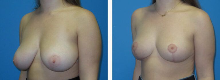 Breast Reduction before and after treatment