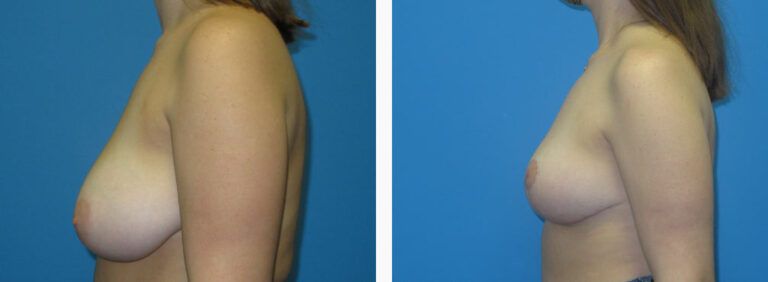 Breast Reduction before and after treatment