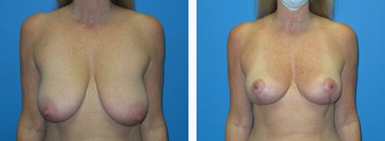 Breast Reduction before and after treatment