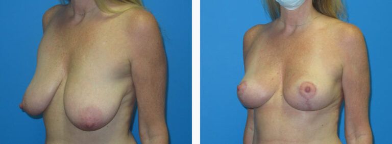 Breast Reduction before and after treatment