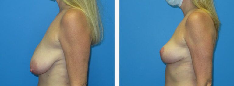 Breast Reduction before and after treatment