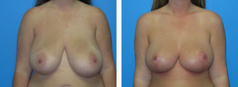 Breast Reduction before and after treatment