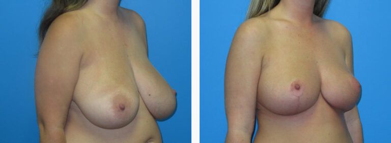 Breast Reduction before and after treatment
