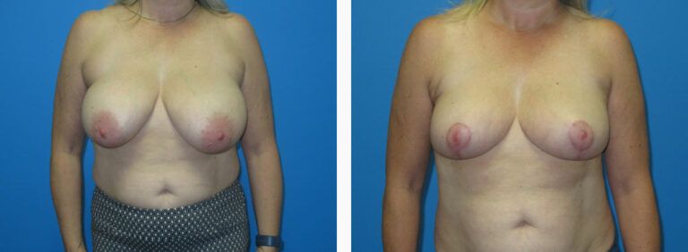 Breast Reduction before and after treatment