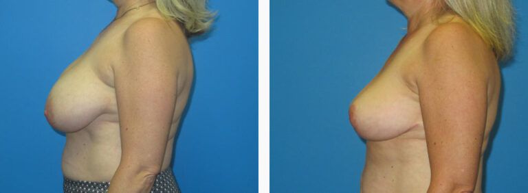 Breast Reduction before and after treatment