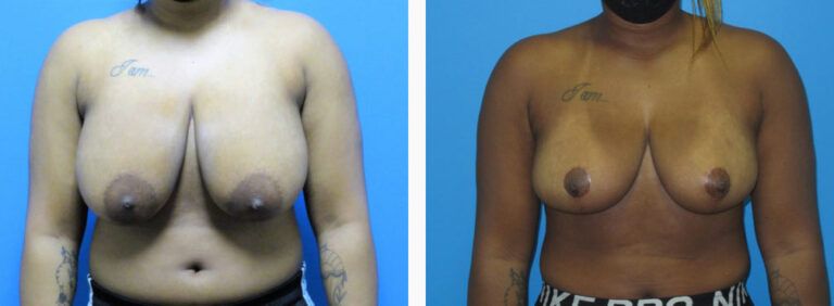 Breast Reduction before and after treatment