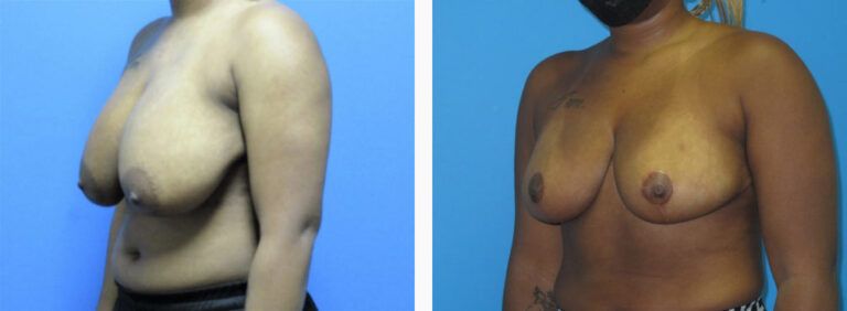 Breast Reduction before and after treatment