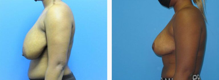 Breast Reduction before and after treatment