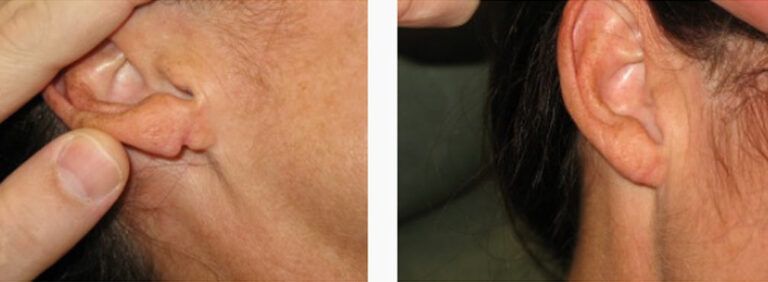 Earlobe Repair before and after treatment