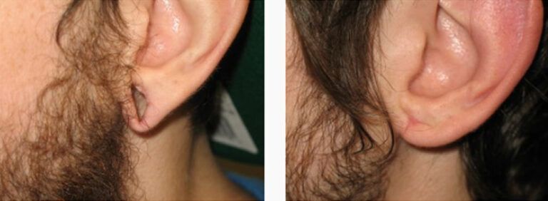 Earlobe Repair before and after treatment