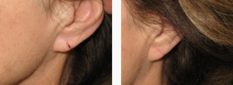 Earlobe Repair before and after treatment
