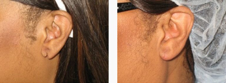 Earlobe Repair before and after treatment