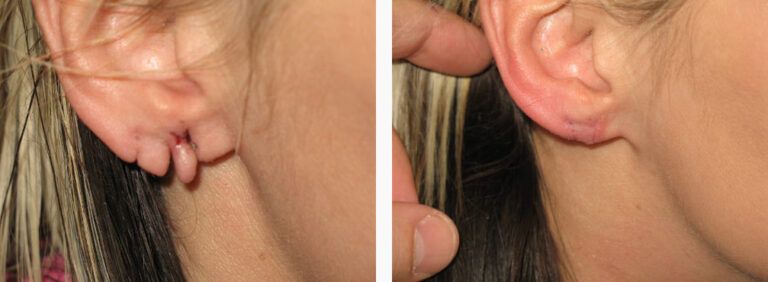 Earlobe Repair before and after treatment