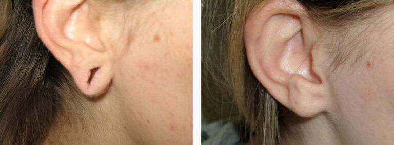 Earlobe Repair before and after treatment