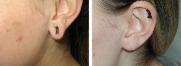 Earlobe Repair before and after treatment