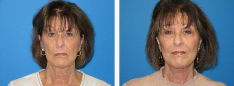 Facelift before and after treatment