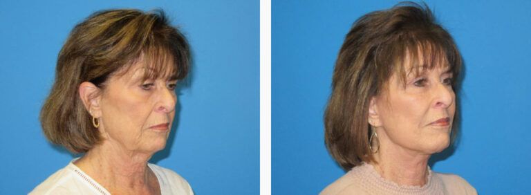 Facelift before and after treatment