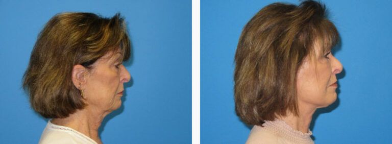 Facelift before and after treatment
