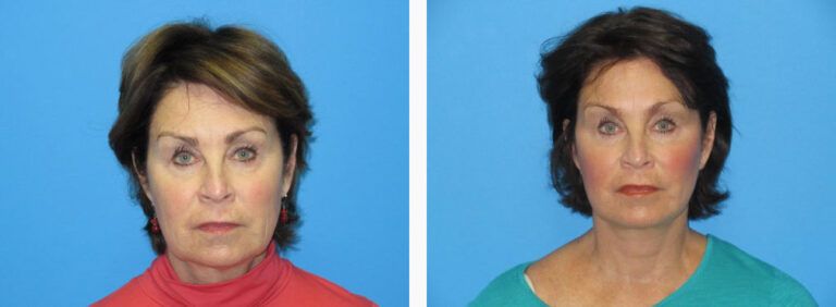 Facelift before and after treatment