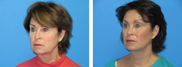 Facelift before and after treatment
