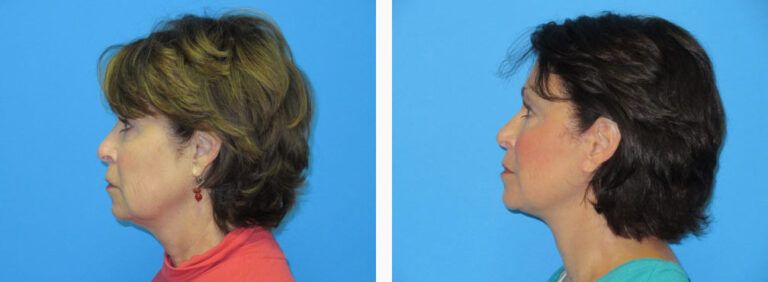 Facelift before and after treatment