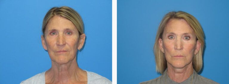 Facelift before and after treatment