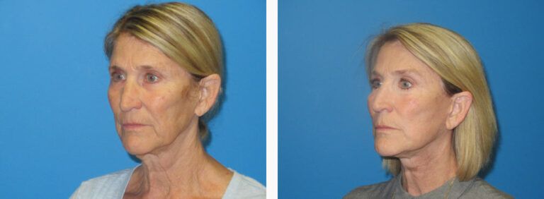 Facelift before and after treatment