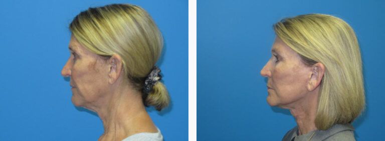 Facelift before and after treatment