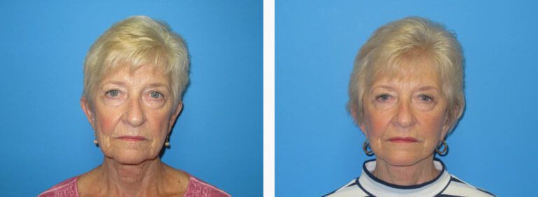 Facelift before and after treatment